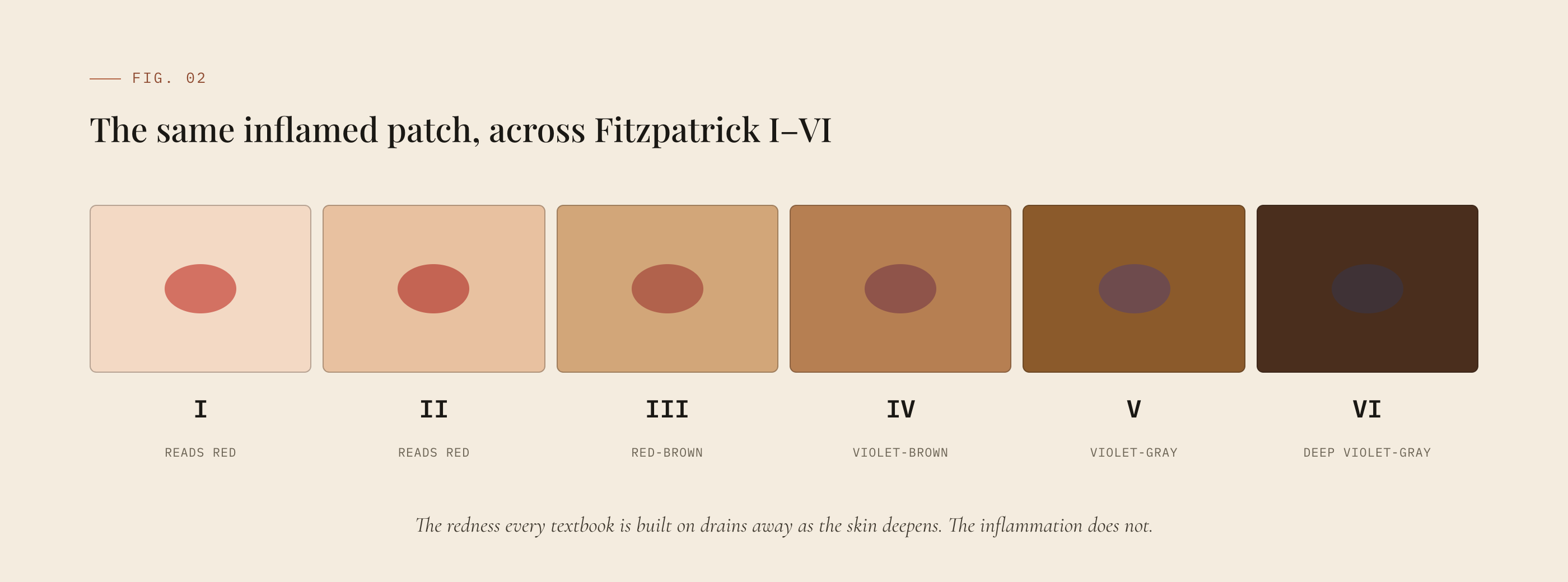 The same inflamed patch shown across Fitzpatrick types I through VI, losing its redness as the skin deepens.